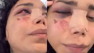 Paola Suárez ya tiene la cara menos hinchada y el ojo más abierto