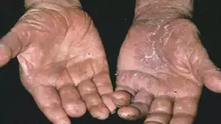 La Secretaría de Salud aclaró que los enfermos se mantienen en tratamiento y observación