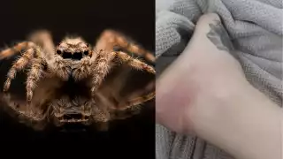 Una mujer fue picada por una araña y pierde la pierna