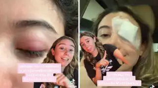 La joven compartió su historia como un ejemplo para no usar cualquier cosa para desmaquillarse