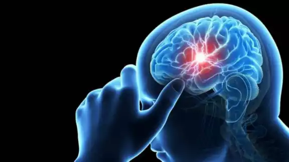 Aproximadamente el 15 por ciento de los pacientes con un aneurisma cerebral roto mueren antes de llegar al hospital. Foto: Pixabay Aproximadamente el 15 por ciento de los pacientes con un aneurisma cerebral roto mueren antes de llegar al hospital. Foto: Pixabay