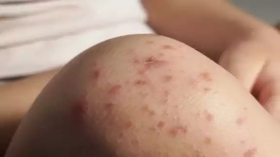 México registra un aumento en casos de sarampión
