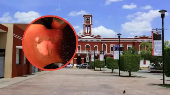 El caso más grave fue de una mujer que se le incendió su cabello