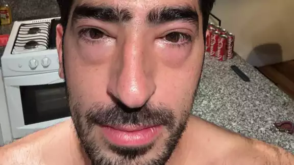 Jezzini amaneció este lunes con los ojos hinchados Jezzini amaneció este lunes con los ojos hinchados