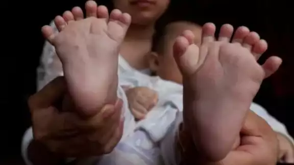 El menor está con excelente salud a pesar del mal congénito. Foto: Especial