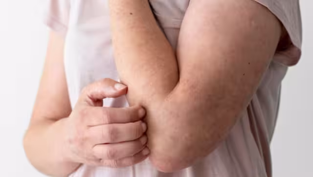 Solamente hay un caso reciente de Lepra en Yucatán