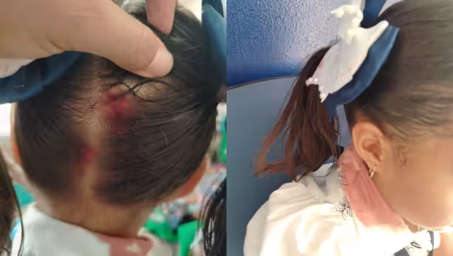 La lesión de la menor requirió seria atención médica