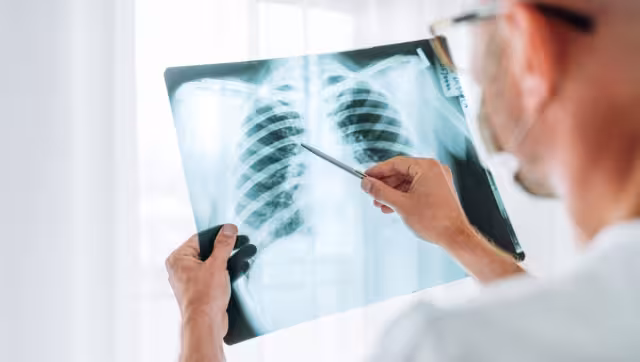 Aproximadamente cuatro mil personas mueren cada año por tuberculosis