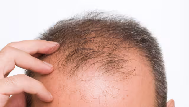 Hoy ser calvo es un signo de belleza. Foto: Especial