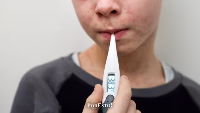 Alerta en Campeche por Sarampión: La Fiebre Alta es el Primer Síntoma