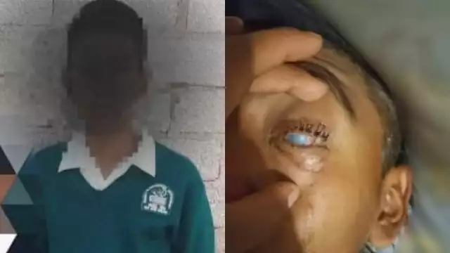 El menor perdió la vista del ojo izquierdo y un 90 por ciento del ojo derecho