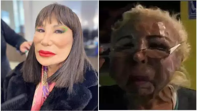 Cirugía tras cirugía, y después de inyectarse colágeno, su rostro se desfiguró pareciendo plastilina derretida, aunque no le causa dolores