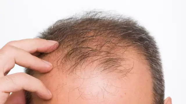 Hoy ser calvo es un signo de belleza. Foto: Especial