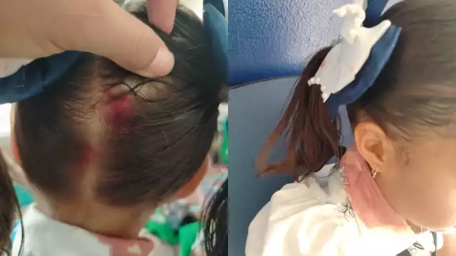 La lesión de la menor requirió seria atención médica