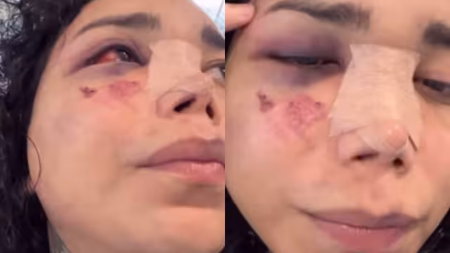 Paola Suárez ya tiene la cara menos hinchada y el ojo más abierto