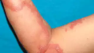 En los últimos dos años, se han detectado 9 casos de lepra en Yucatán. Fotos: Óscar Suaste.