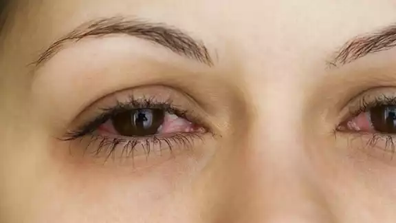 Esta infección se transmite a través de las secreciones de los ojos y de las vías respiratorias superiores. Esta infección se transmite a través de las secreciones de los ojos y de las vías respiratorias superiores.