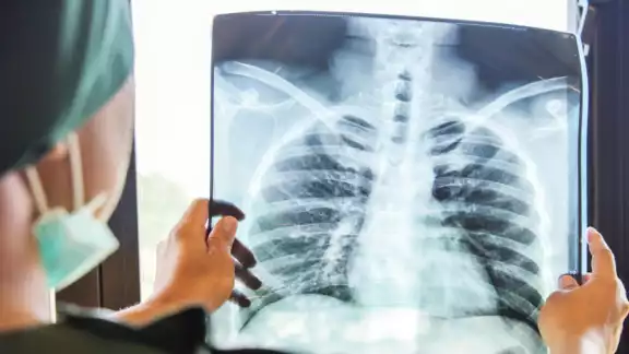La tuberculosis es un padecimiento respiratorio que se puede prevenir mediante la vacuna. Foto: Internet.