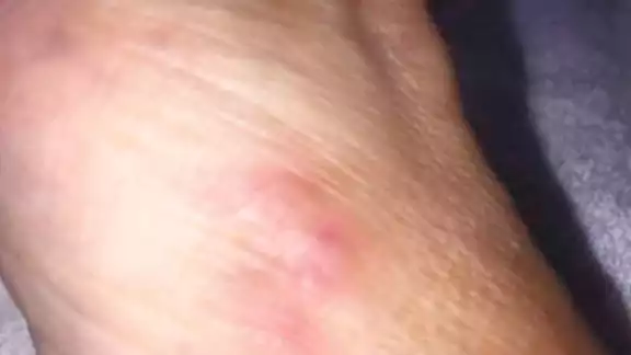 Este problema cutáneo se adquiere al tener contacto directo con tierra o arena contaminada. Fotos: Por Esto!