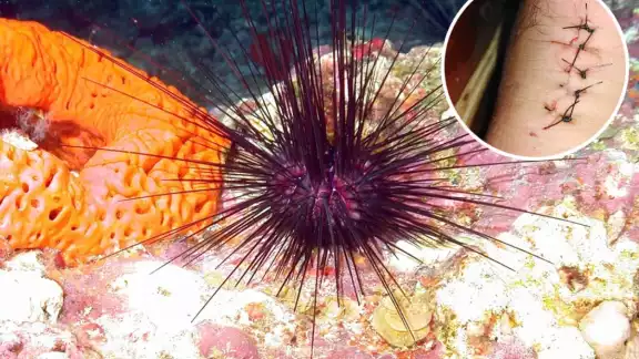 En caso de golpear un erizo de mar, comprueba si alguna de sus agujas quedó adherida a tu piel En caso de golpear un erizo de mar, comprueba si alguna de sus agujas quedó adherida a tu piel