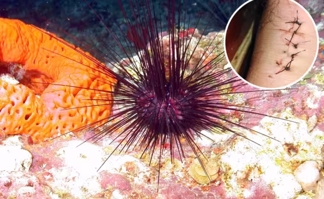 En caso de golpear un erizo de mar, comprueba si alguna de sus agujas quedó adherida a tu piel