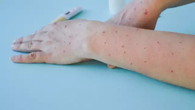 La OMS ha declarado a la viruela del mono como emergencia de salud pública de interés internacional