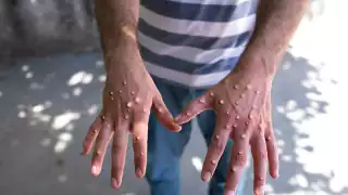 Campeche con tres nuevos casos sospechosos de viruela símica