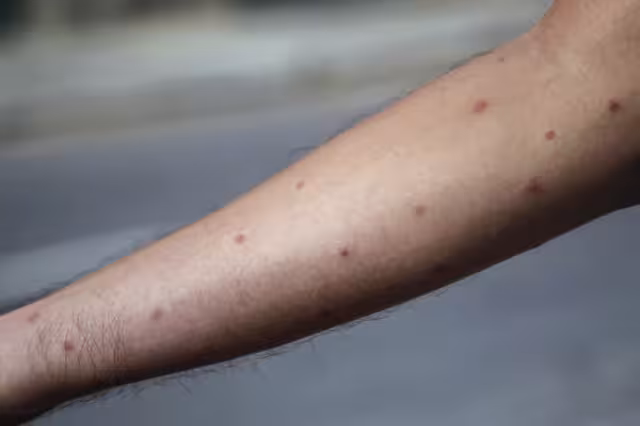 La viruela del mono se ha puesto en alerta sanitaria a todo el mundo