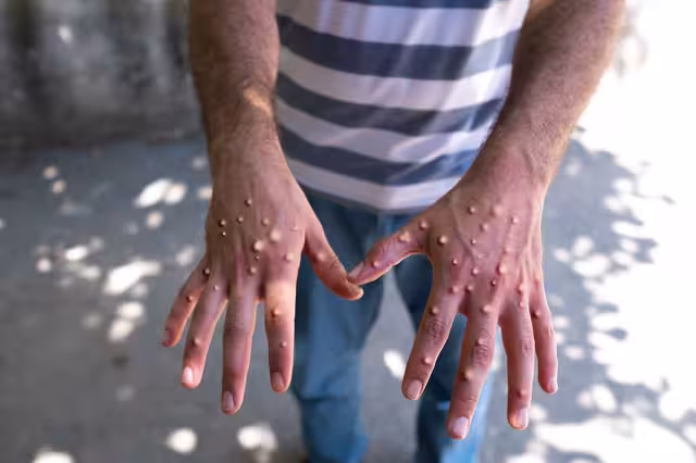 De los nueve casos de la viruela del mono detectados en Quintana Roo, siete fueron confirmados y dos más son sospechosos