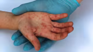 El sarampión, que parecía erradicado, reaparece en Yucatán y exhibe las grietas de la vacunación