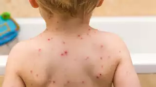   Varicela en Yucatán: ¿Cómo prevenir a los niños de contagiarse?  