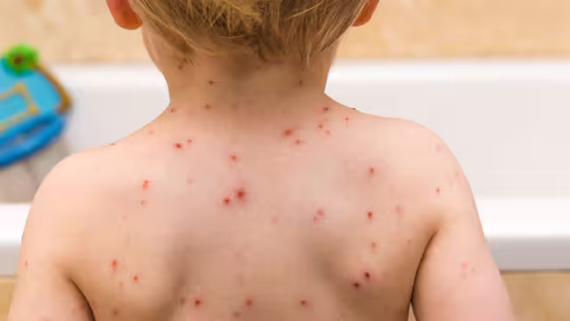 Yucatán enfrenta un aumento en los casos de dengue