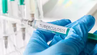 Tuberculosis en Quintana Roo: Todo lo que debes saber sobre la vacuna