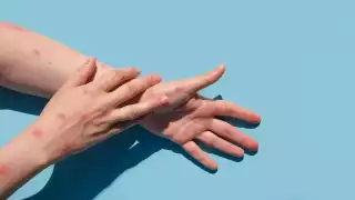 Confirman primer caso de mpox y advierten otros dos contagios sospechosos en Asia