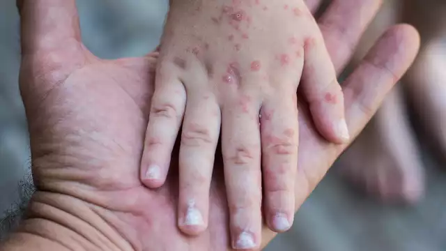 Padres de familia en Yucatán han comenzado a tomar precauciones del virus Coxsackie