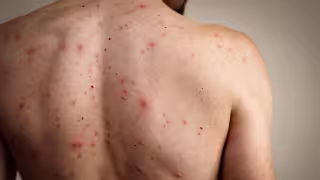 ISSSTE Campeche desmiente casos de sarampión en sus unidades médicas