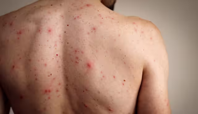 ISSSTE llama a derechohabientes a evitar automedicación ante síntomas sospechosos