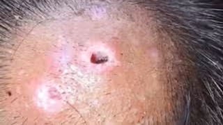 Campeche registra siete casos de gusano barrenador en humanos