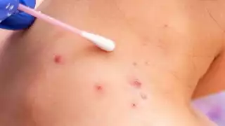 El aumento de contagios de la viruela del mono en Quintana Roo se dio a conocer este 30 de agosto por medio de la SSA