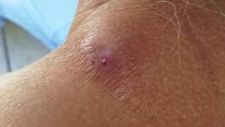 Ante casos de miasis cutánea humama piden reforzar vigilancia sanitaria en Quintana Roo