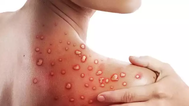 El aumento de contagios de la viruela del mono en Quintana Roo se dio a conocer este 23 de agosto por medio de la SSA