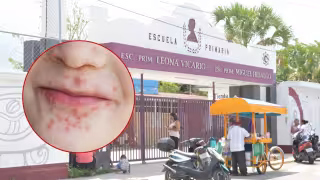 Detectan caso de coxsackie en un jardín de niños de Cozumel