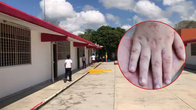 Cancelan clases en Calderitas por virus Coxsackie: Van 79 casos confirmados hasta ahora