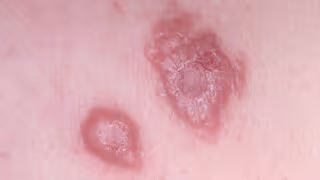 Quintana Roo lidera los casos de leishmaniasis cutánea en el país