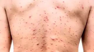 La alta incidencia de enfermos colocó a la entidad en el tercer lugar a nivel nacional, por encima de Ciudad de México y Baja California.