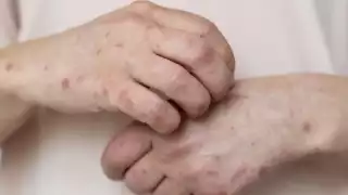   Día Mundial de la Alergia: Estas son las más comunes en Yucatán  