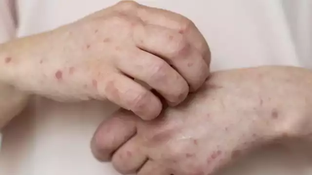 Las alergias pueden ser causadas por distintos factores