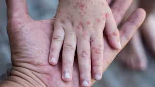 Alerta por sarampión en Campeche: confirman 18 casos en 2026, más que el año pasado