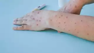 La CDMX es la entidad federativa con más casos de esta enfermedad endémica en África