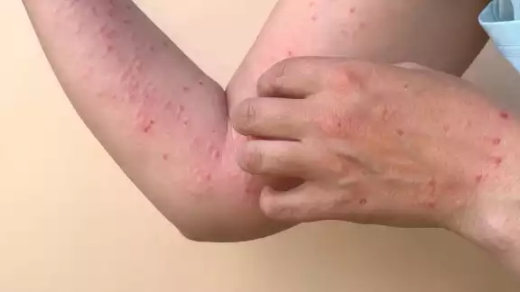 Casi 100 contagios de viruela del mono en México en los últimos días Casi 100 contagios de viruela del mono en México en los últimos días